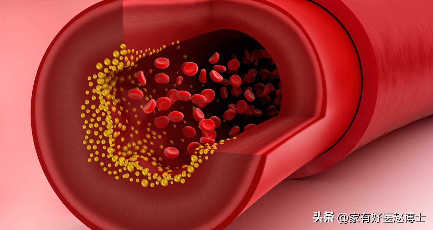 颈动脉没有斑块可以停用他汀吗,一般他汀吃多久颈动脉斑块有效果