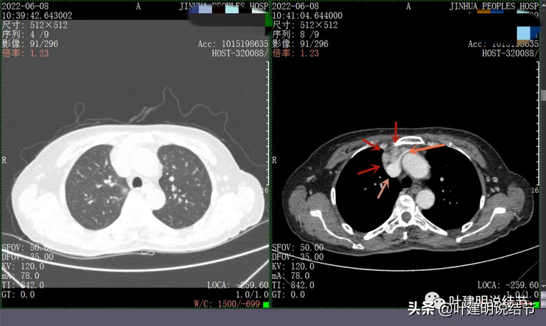 这位老乡，乏力来查，查出这么大个的纵隔肿瘤！会是什么呢？