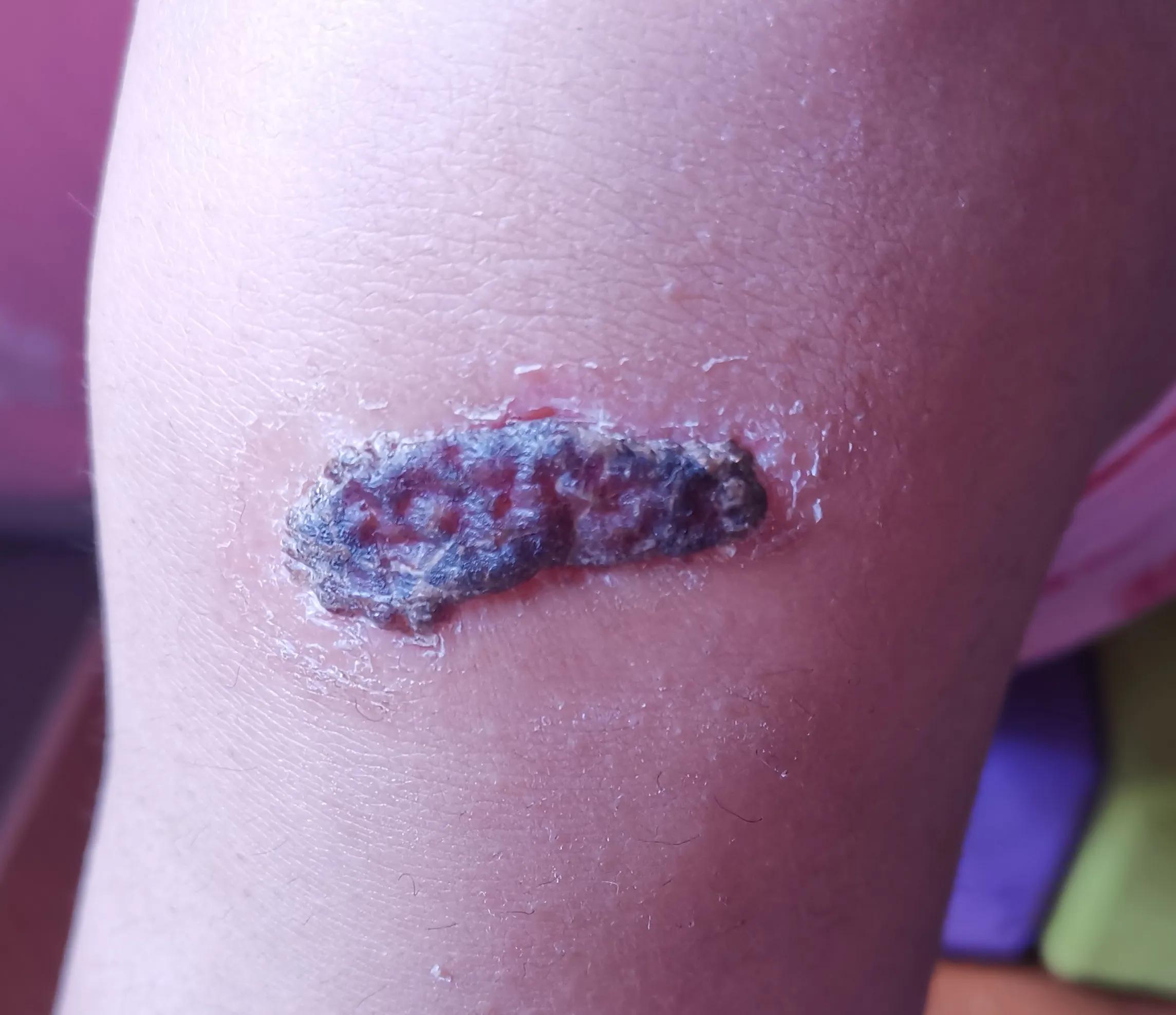 磕伤已经结痂需要做什么处理,擦伤磕伤的正确处理方法