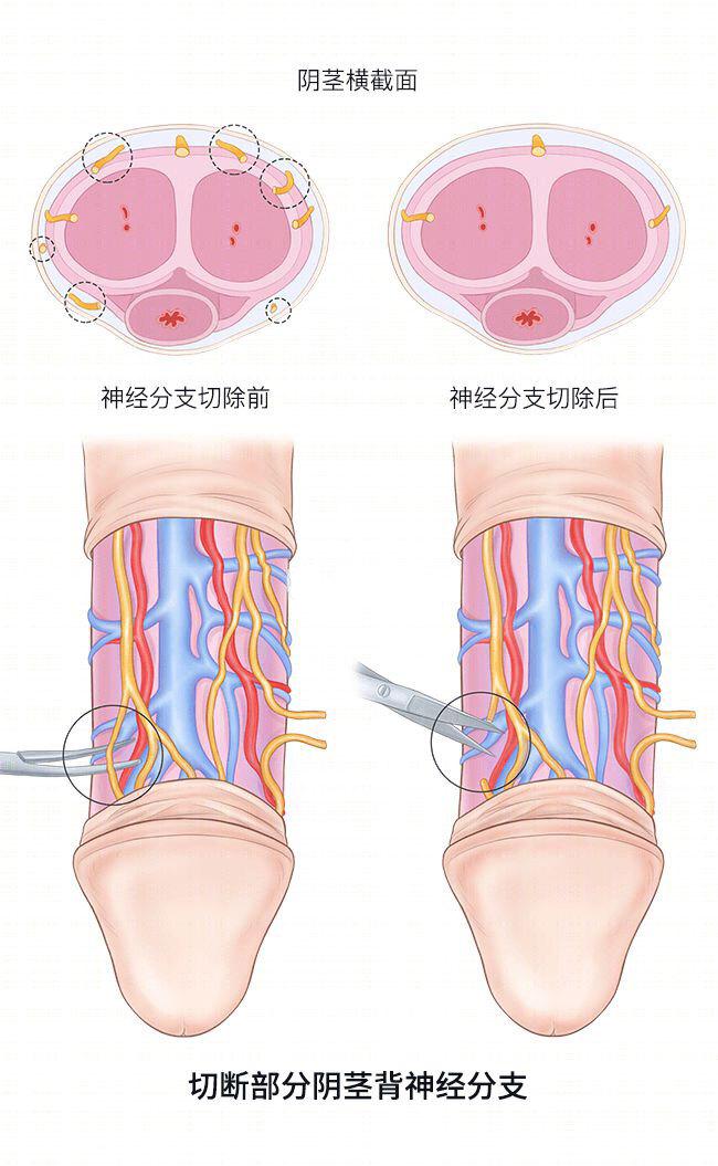 为了延时，阴茎背神经阻断术值不值得做？救命稻草还是治疗陷阱？