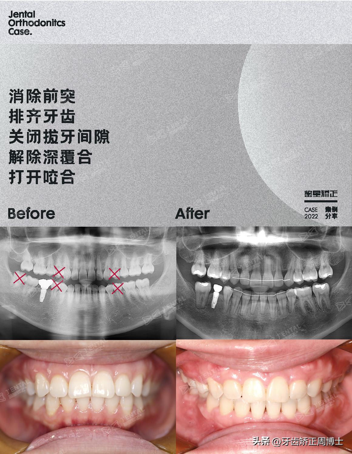 骨性前突正畸后多长时间有效果,牙性下巴后缩可以戴牙套改善吗