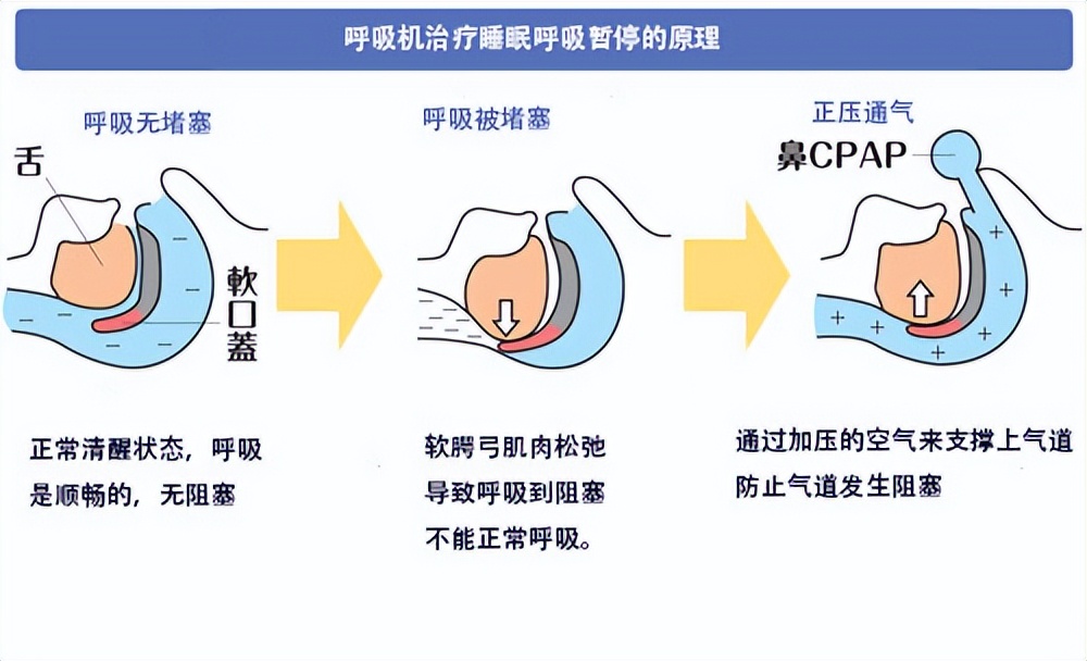 呼吸机能根治打呼噜吗,飞利浦567呼吸机治疗打呼噜参数