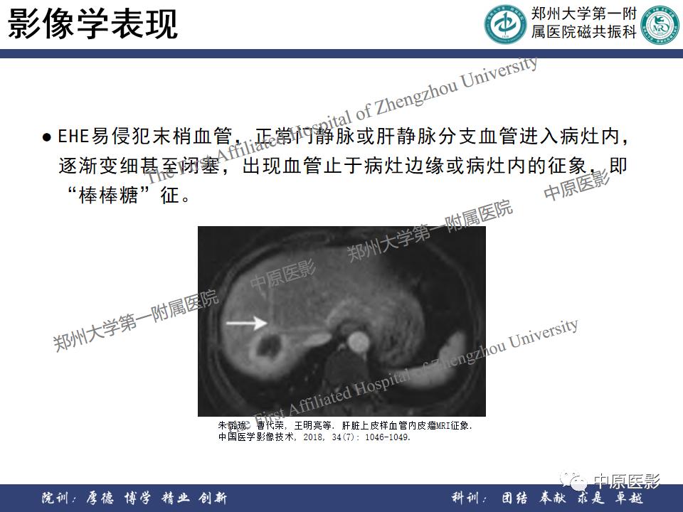 肝脏血管瘤样本,正确认识肝脏血管瘤文章