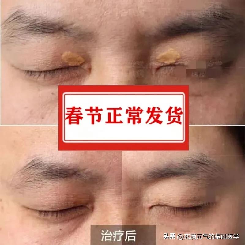 你见过吗，一些中年女性眼睑黄黄的两坨