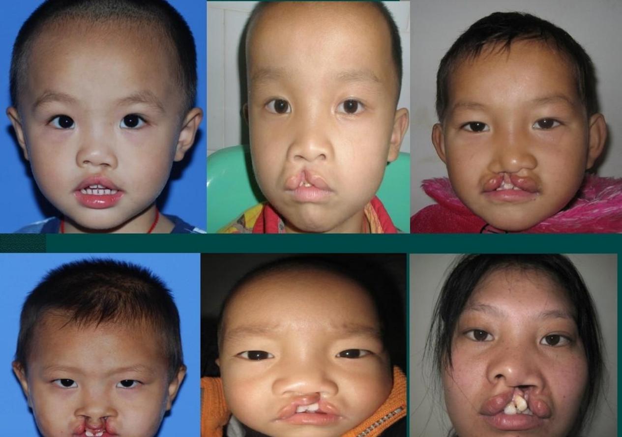 王菲女儿唇裂是哪个医生做的,王菲女儿兔唇怎么治好