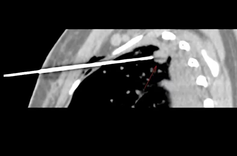 肺癌egfr阳性吃靶向药能活几年,肺癌靶向治疗基因检测egfr