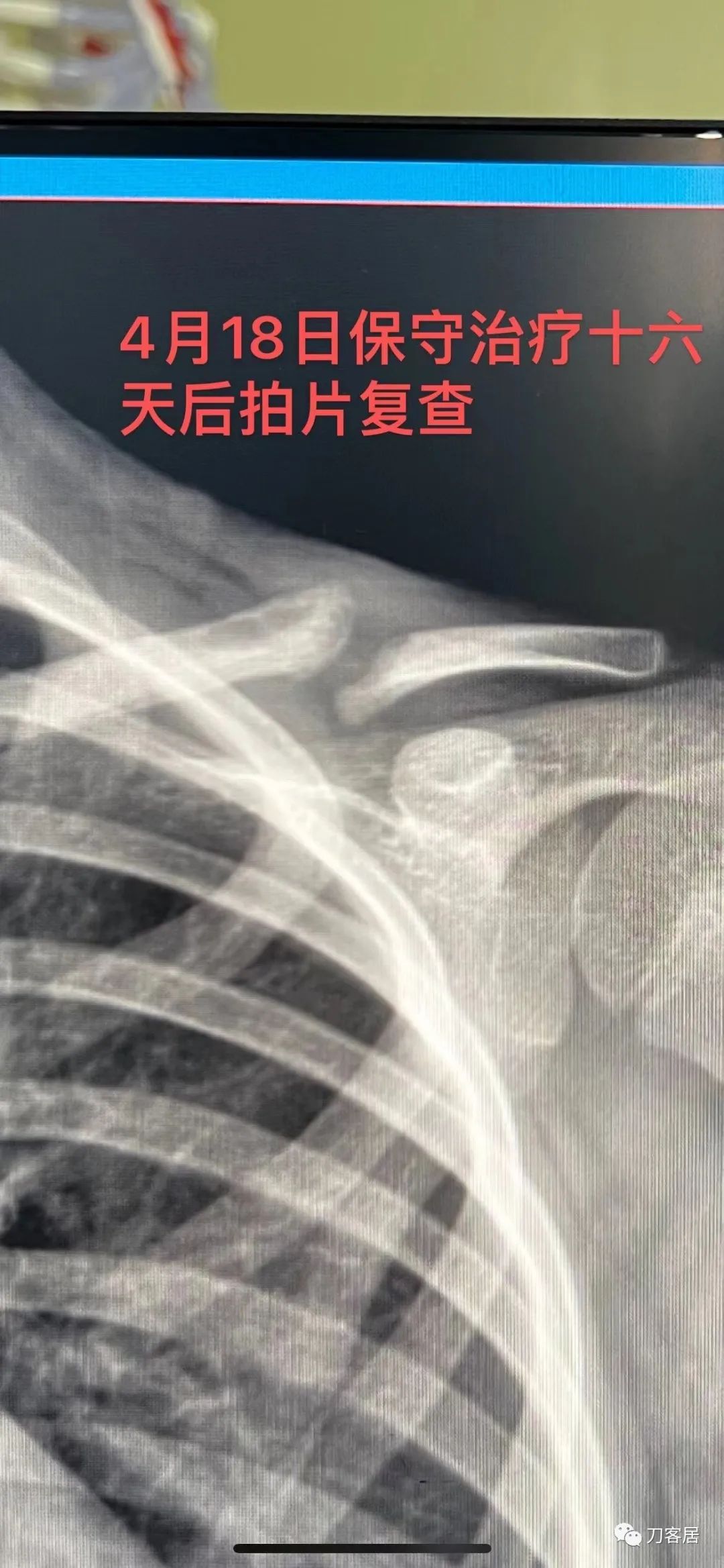 儿童锁骨骨折保守治疗的弊端,锁骨粉碎骨折错位不处理会愈合吗