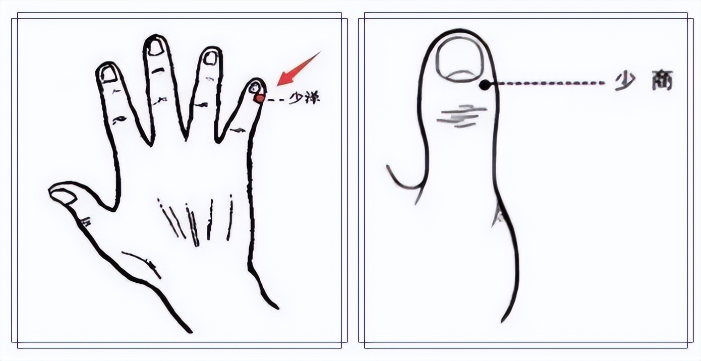 “少泽穴放血”治妇人乳病、乳汁不通、乳腺炎