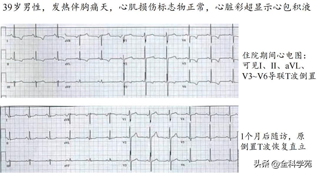 t波倒置三种常见原因,t波低平倒置有事吗