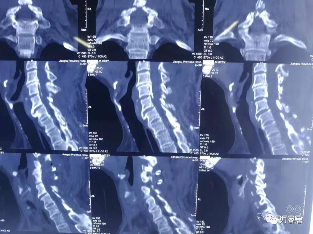 颈椎椎管内肿瘤手术20例麻醉处理,颈椎脊髓内肿瘤手术成功案例