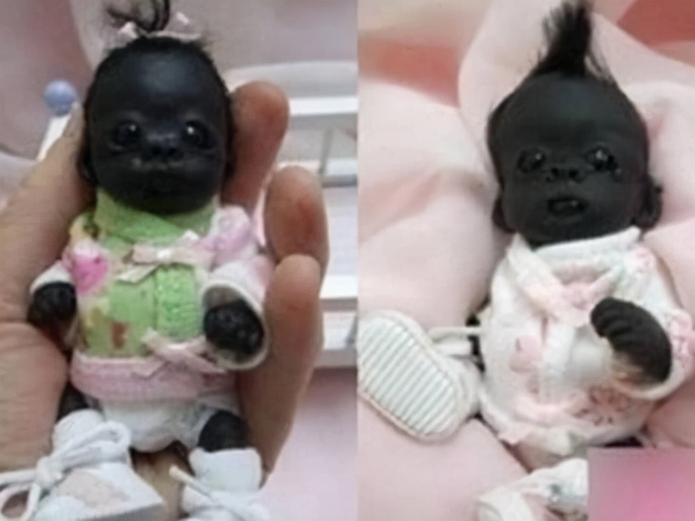 故事:非洲17岁女孩长满络腮胡,毛发从鼻孔长到脖子,身体有何异常