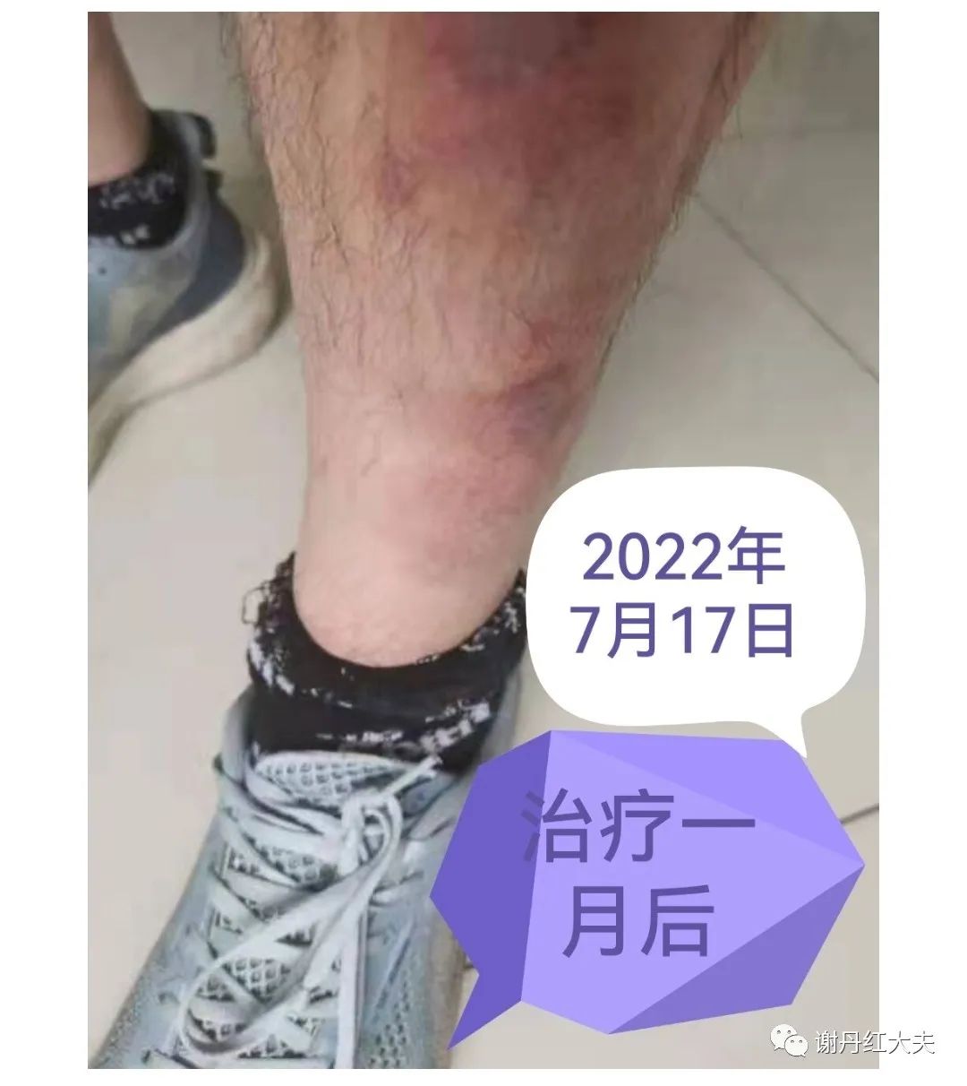 胫前黏液性水肿见于哪些病,胫前黏液性水肿为凹陷性水肿吗