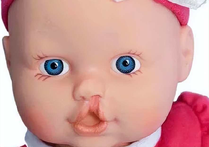 婴儿唇腭裂怎么护理,唇腭裂麻醉