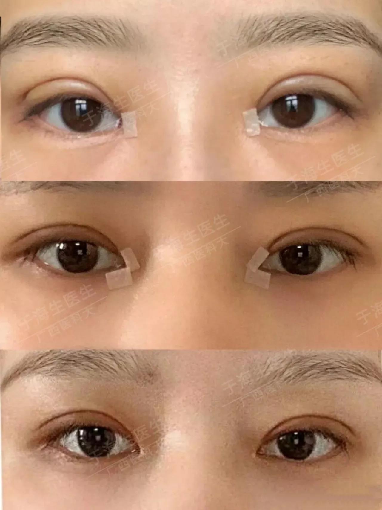 现在双眼皮修复都是什么手法,双眼皮修复怎么样才最好看