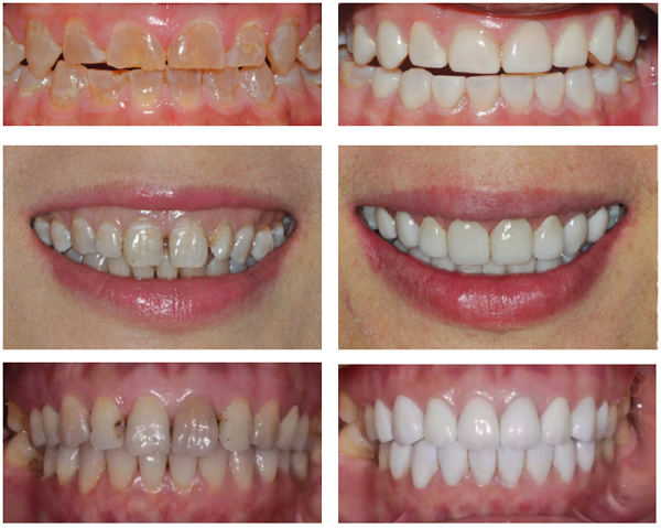 烤瓷牙好不舒服,烤瓷牙好不好看