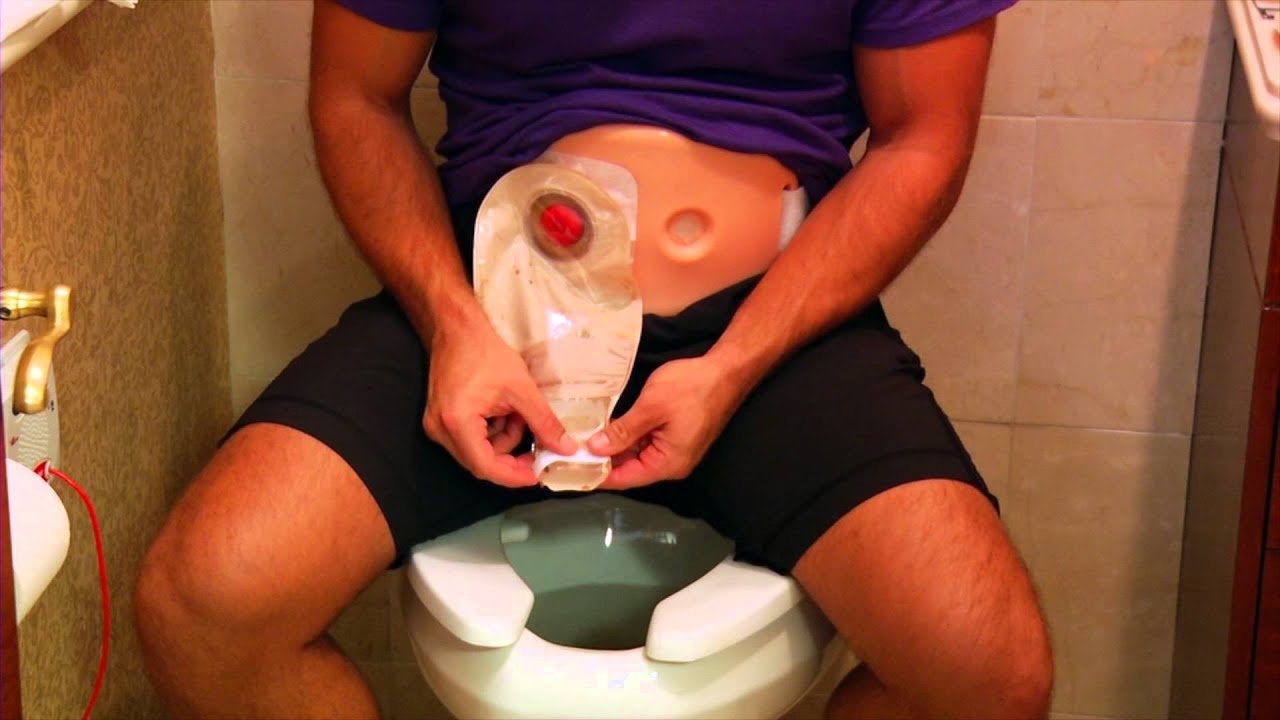 没有大便肛门却流血要怎么治疗,正常人怎么排便