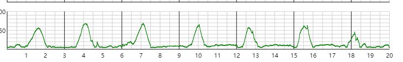 胎心监护宫缩100但没感觉到宫缩,胎心监护宫缩170不宫缩时150