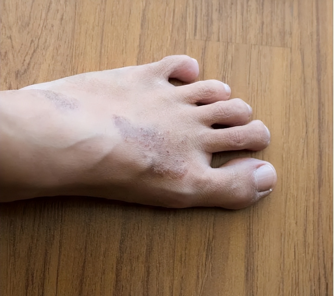 梅毒脚的典型表现!多数人却以为是得了脚气,白白耽误了病情