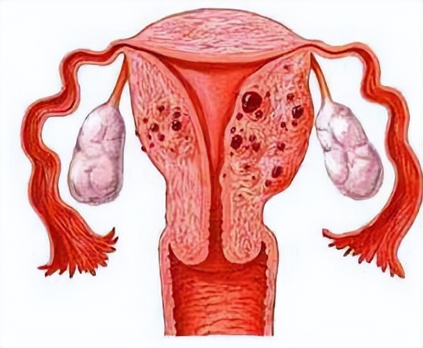 卵巢囊肿彩超查不出怎么办,卵巢囊肿ct显示无病变
