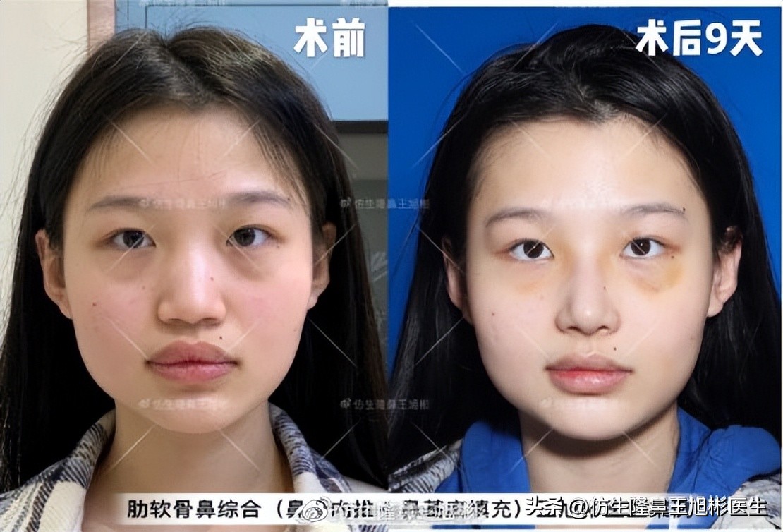 鼻翼缩小可以改善鼻翼缘后缩吗,鼻翼肥大如何正确改善