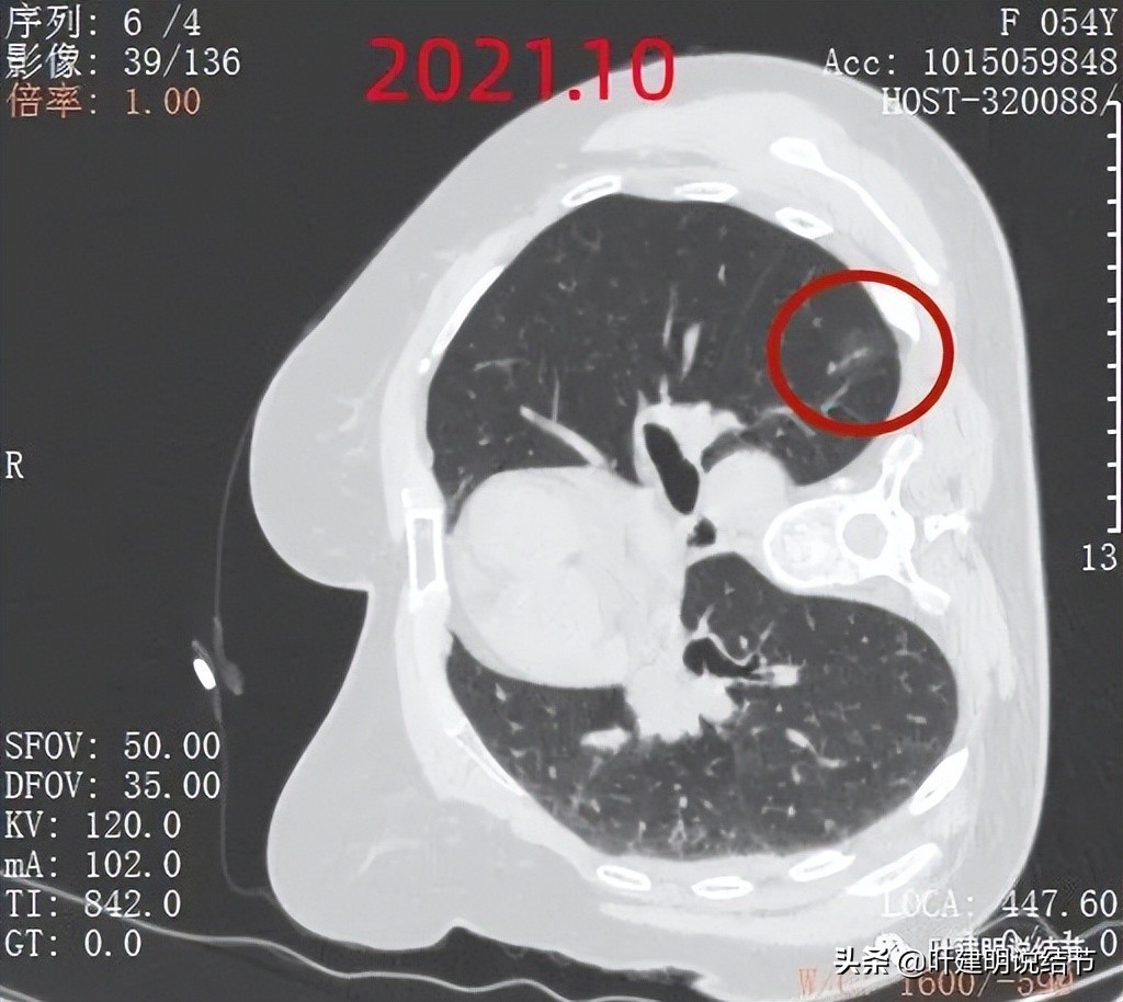 病例分享：这种样子的错构瘤？我是第一次见