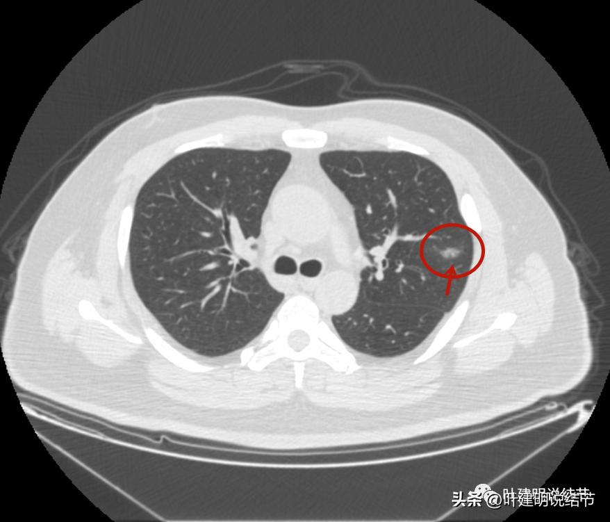 如何判断肺磨玻璃结节是高危结节,肺上有混合磨玻璃结节要注意什么