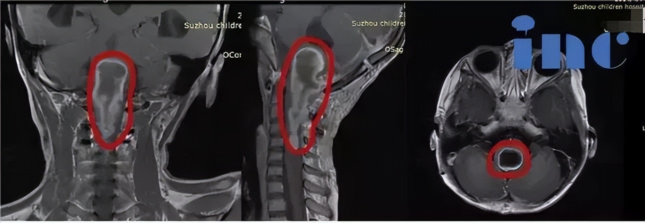 小儿脑瘤并非都治愈无望！家长关心的热点问题汇总答疑