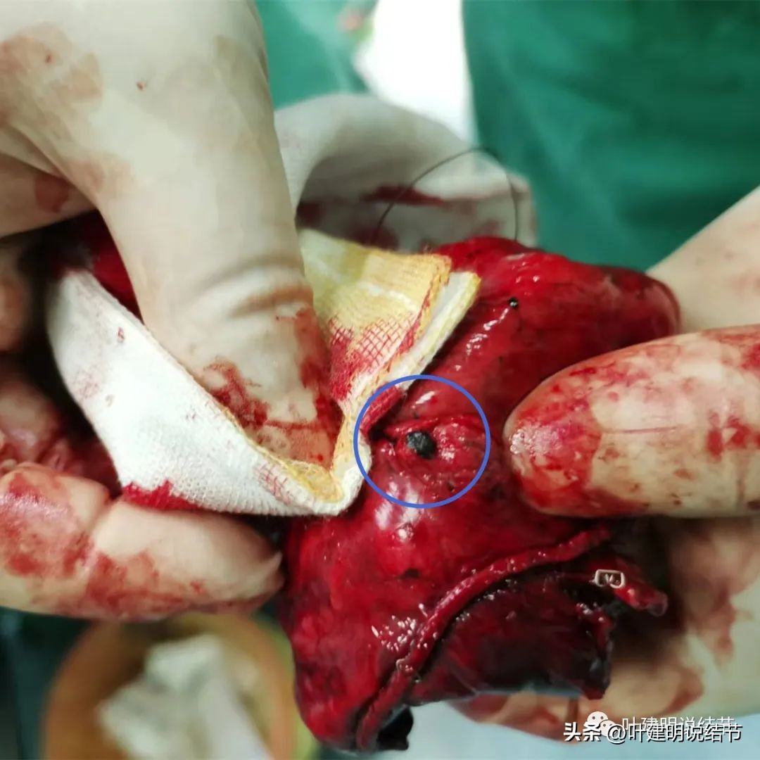 中叶多发微小结节,男性30岁右侧甲状腺单发结节