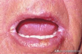 可以常吃维生素B2吗？有什么副作用吗？医生告诉你答案