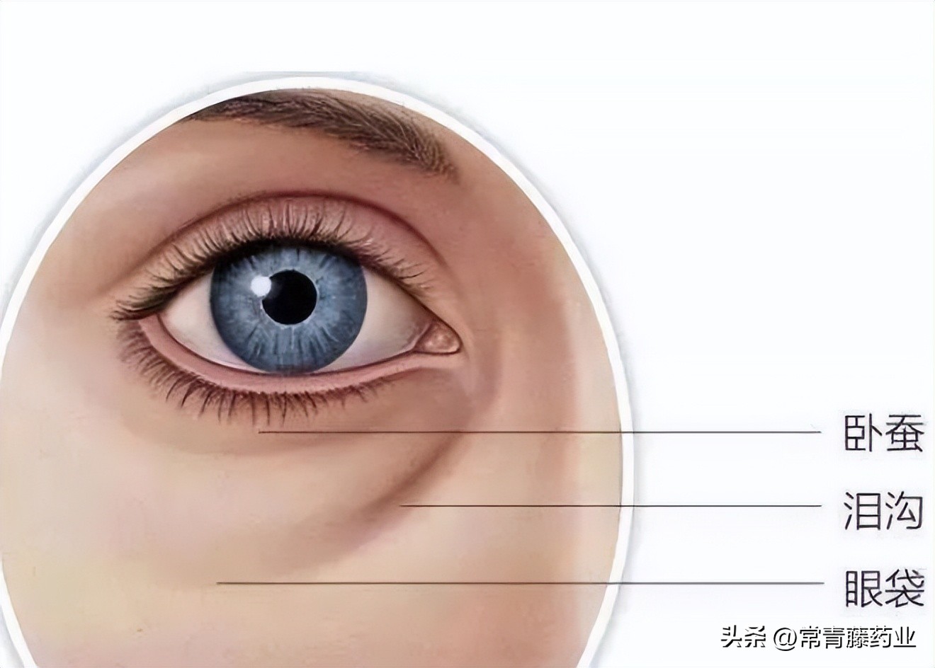 怎样预防缓解泪沟和眼袋,眼袋泪沟的原因及解决方法