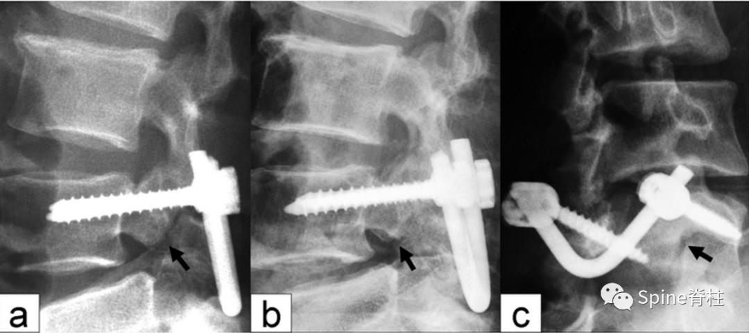 轻度峡部裂和重度峡部裂的区别,真性峡部裂和假性峡部裂