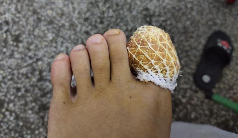 脚趾甲往肉里长又疼又痒教你一招,脚趾甲总往肉里扎该怎么办