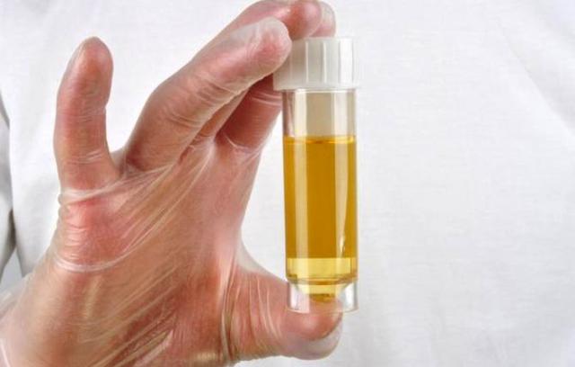 排尿很黄异味很大是什么病的信号,排尿很黄还有分泌物怎么回事