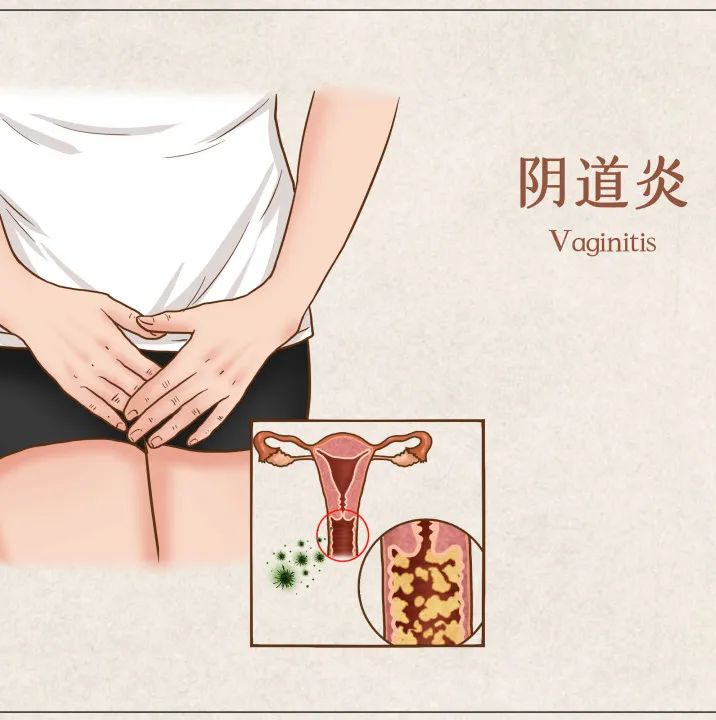 门医科普|反复外阴瘙痒不一定是阴道炎症
