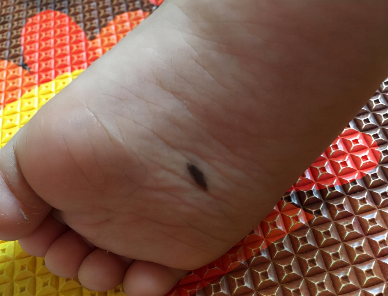 留意黑痣癌变五个重要形态,黑痣比较大才需要引起重视吗