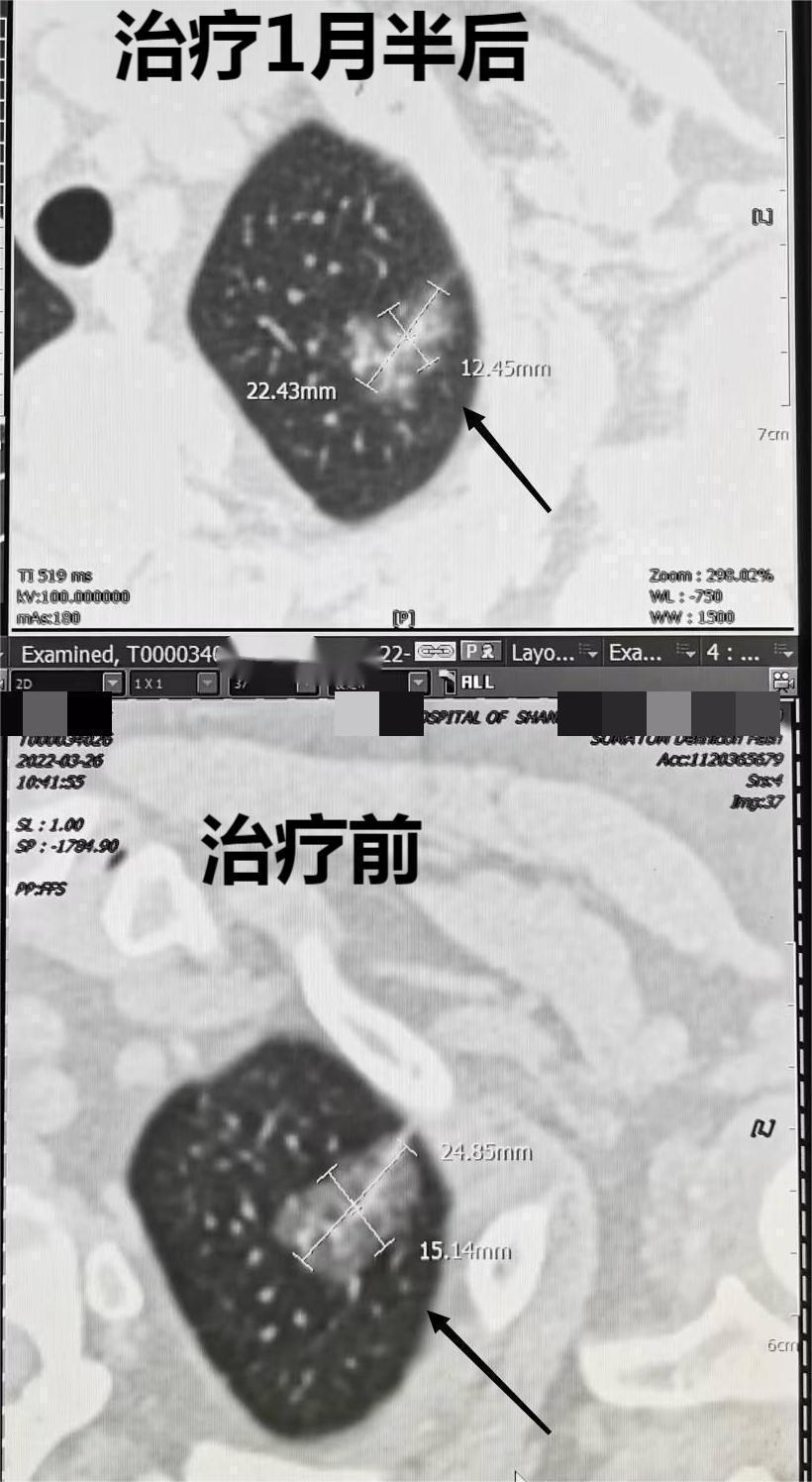 从实例治疗效果看，维生素C可以缩小肺部包块
