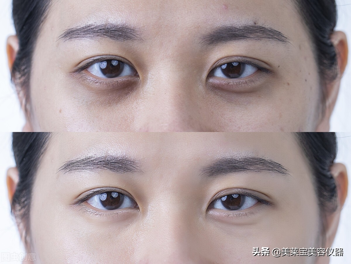 激光和射频祛黑眼圈哪个好,射频美容仪能消除眼袋吗