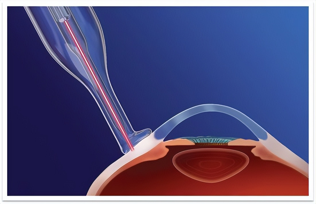 郑州卓美眼科成功开展河南首例微脉冲激光CycloG6睫状体光凝术