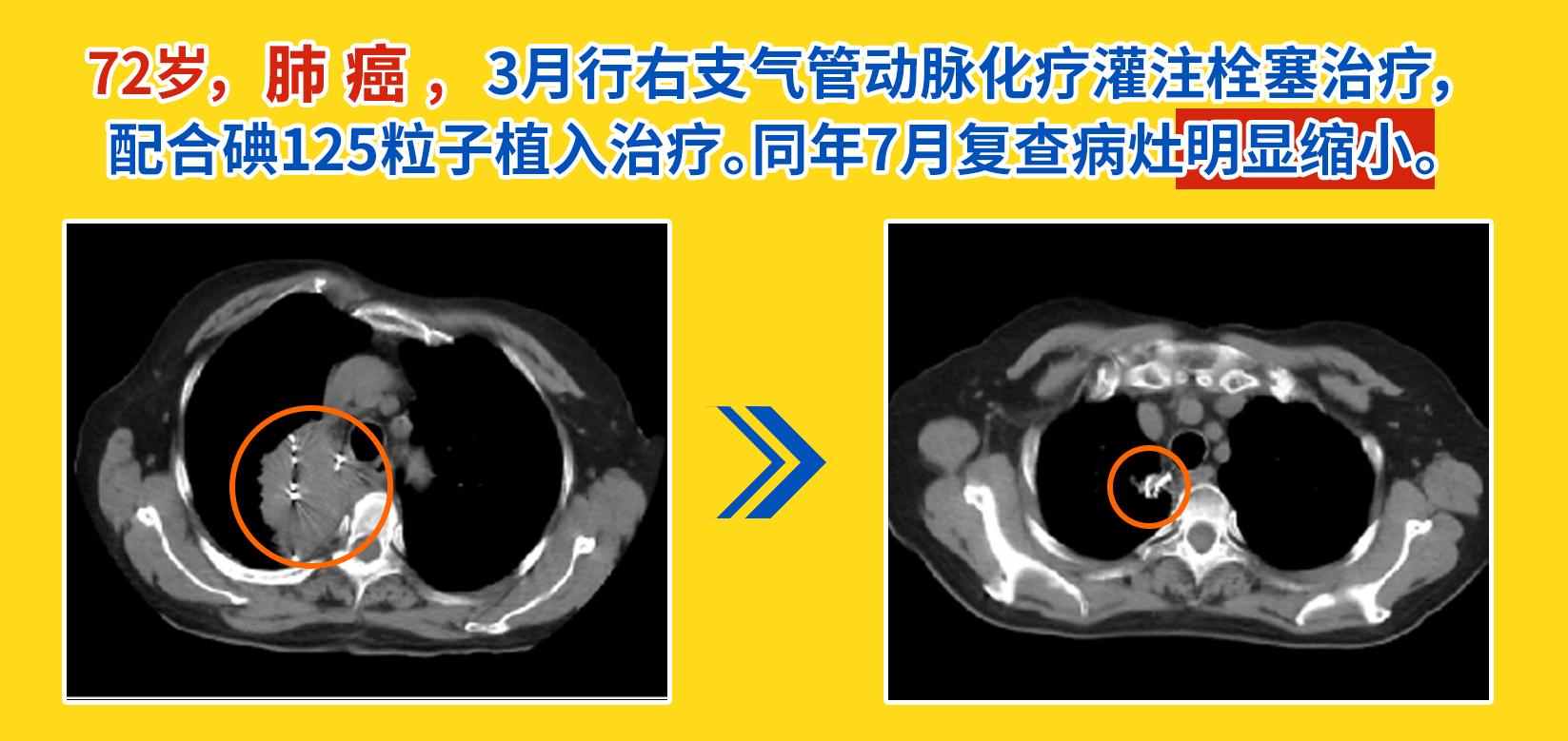 粒子植入术：一根针“排兵布阵”，精准剿灭癌细胞