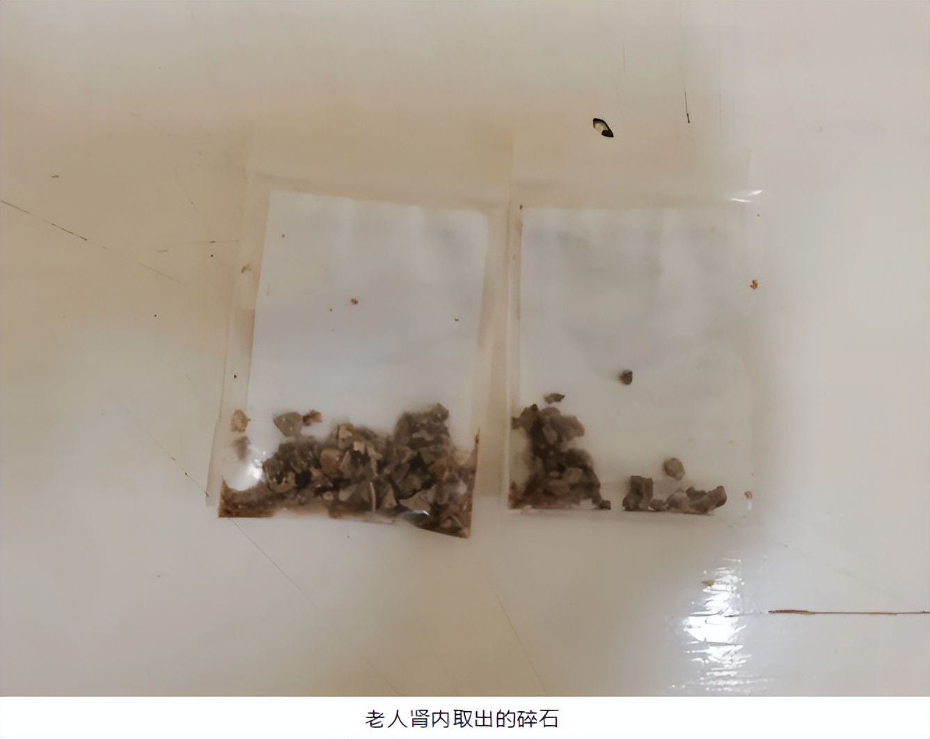 老人长肾结石,老人肾结石8cm严重吗