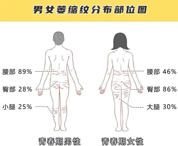 大腿上有白色条纹怎么回事,大腿两侧有白色条纹