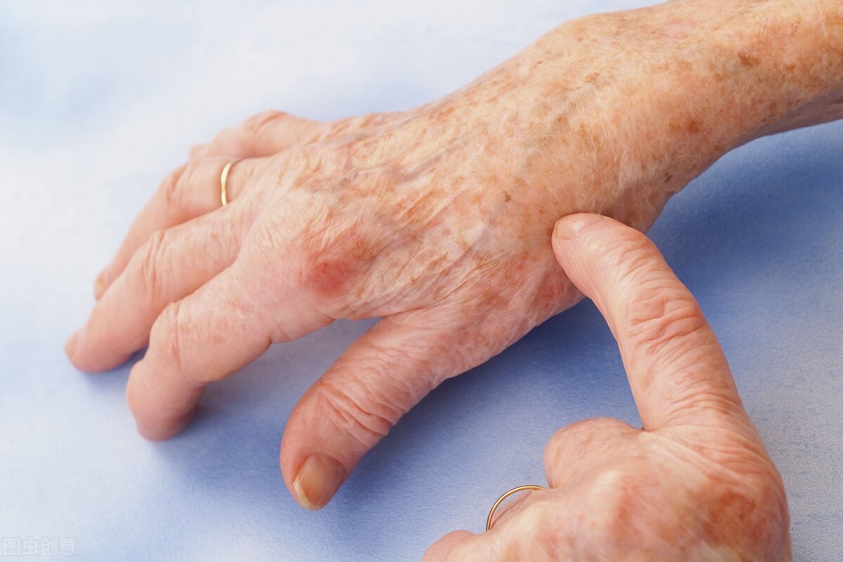 痛风病人治疗期间高烧不断为什么,痛风住院后还末全痊愈是什么原因