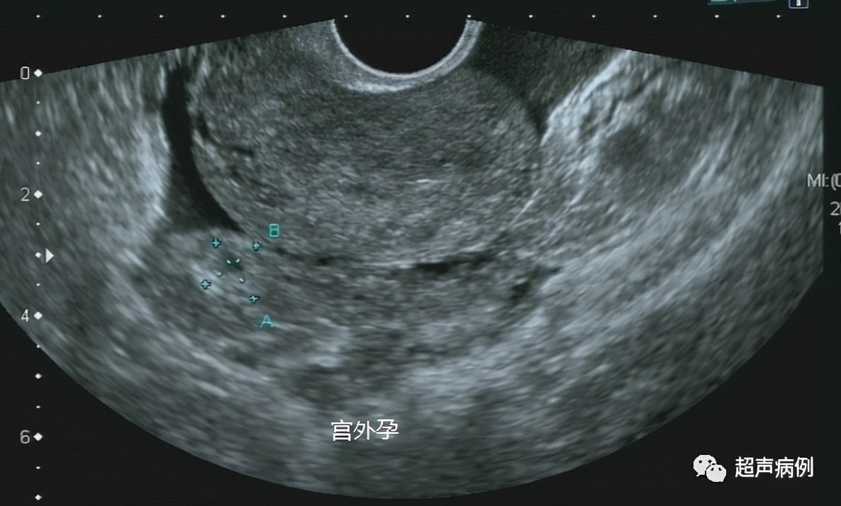 做阴道B超是一种什么样的体验?