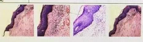 66岁患者宫颈癌复发，通过治疗恢复良好