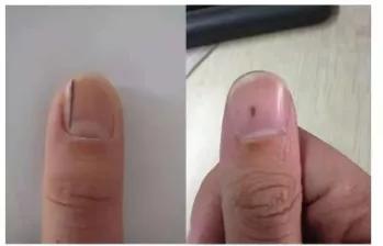 指甲出现黑线是什么病,指甲出现黑线怎么治疗