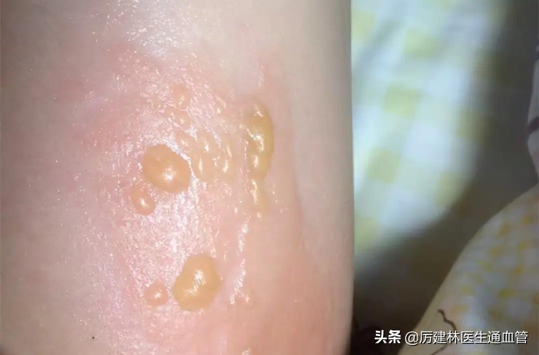 红霉素软膏和红霉素眼膏有何区别,红霉素软膏和红霉素眼膏具体区别