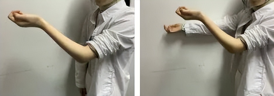 肘关节骨折僵硬康复训练后肿了,肘关节骨折后僵硬的原因