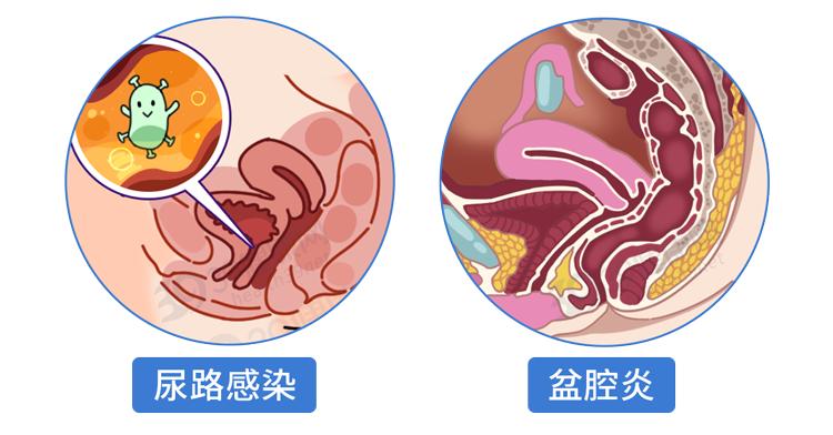 阿莫西林是好药但只对四种病有效,阿莫西林别滥用只针对这六种病