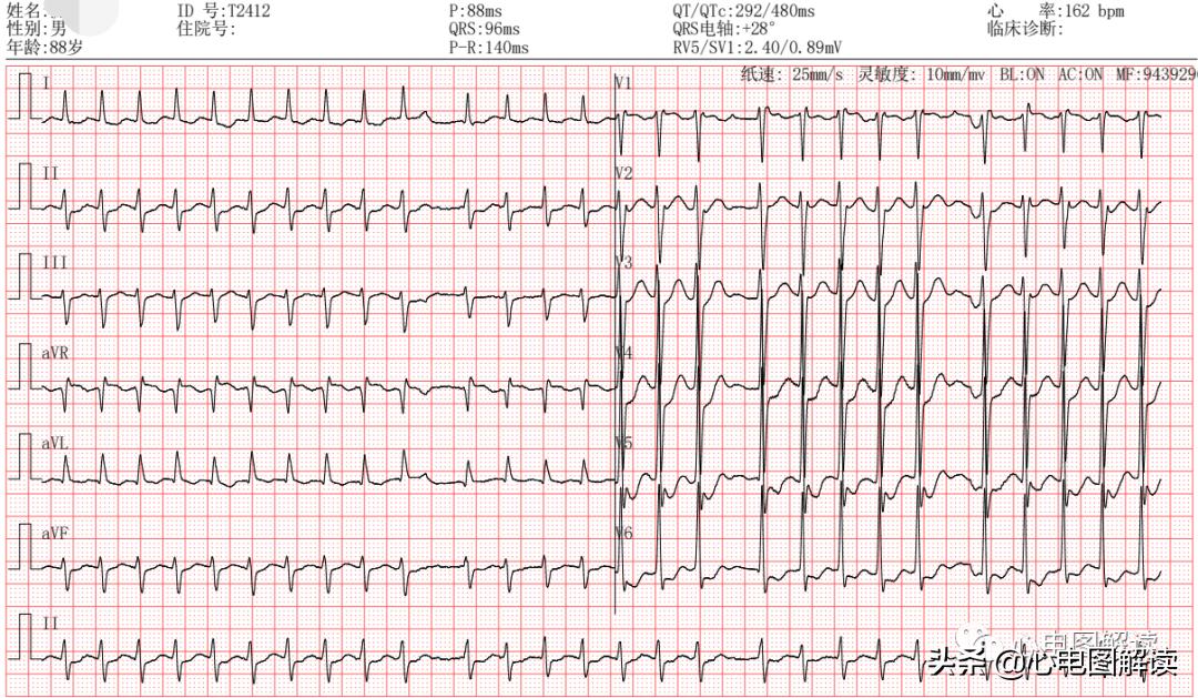 心房颤动三大临床表现,心房颤动的症状视频