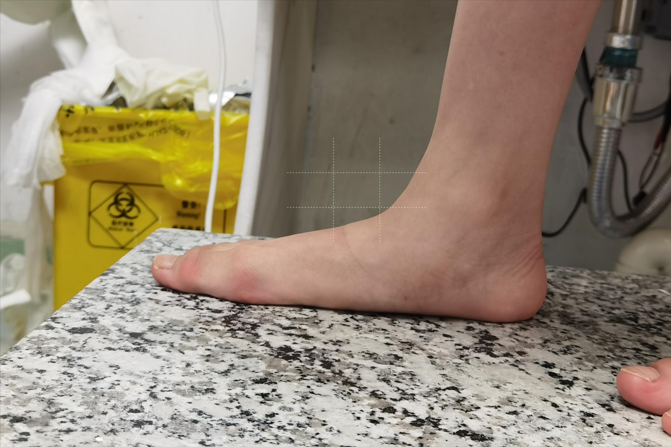 扁平足穿鞋垫能矫正过来吗,僵硬型扁平足矫正鞋垫有效果吗